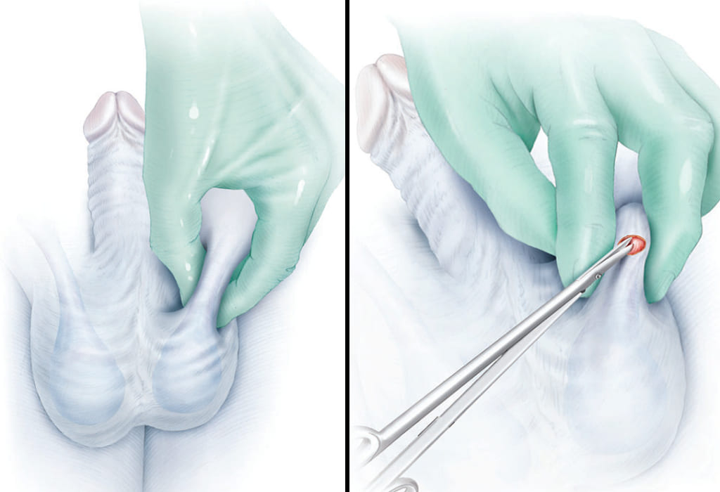 Precio de vasectomía sin bisturí