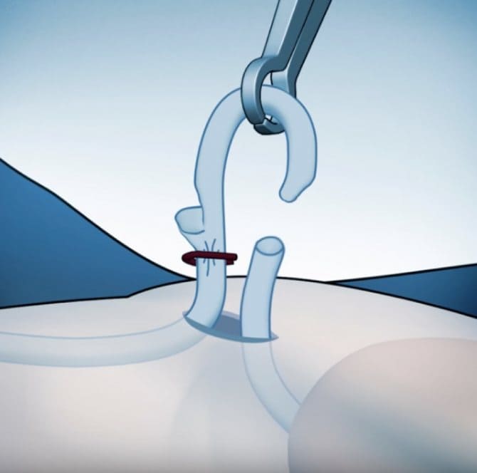 Vasectomía sin bisturí precio cerca de zona plateada, Pachuca